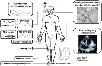 Microcirculation-guided resuscitation in sepsis: the next frontier?